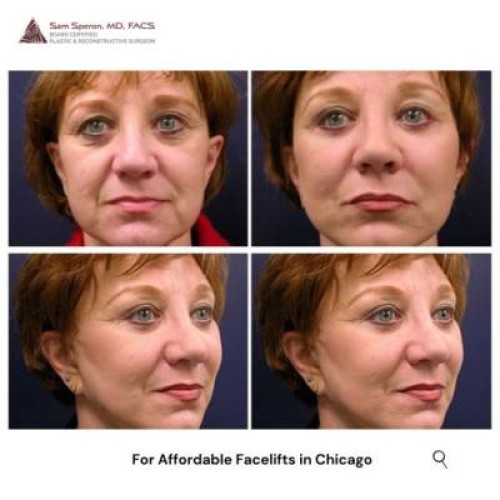 Chicago Facelift Surgeon