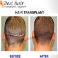 Best Hair Transplant Surgery Delhi India